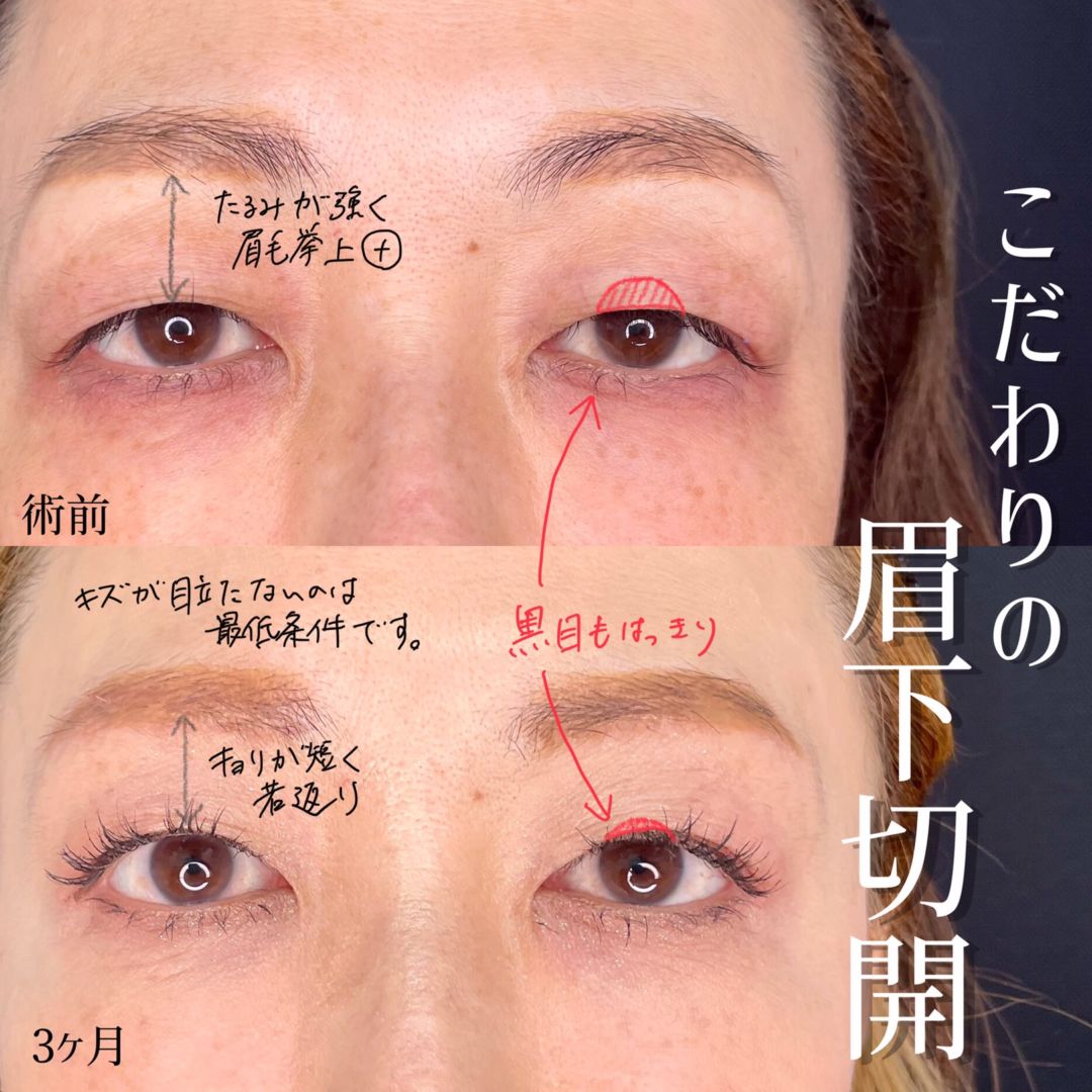大宮の50代女性の眉下切開の症例