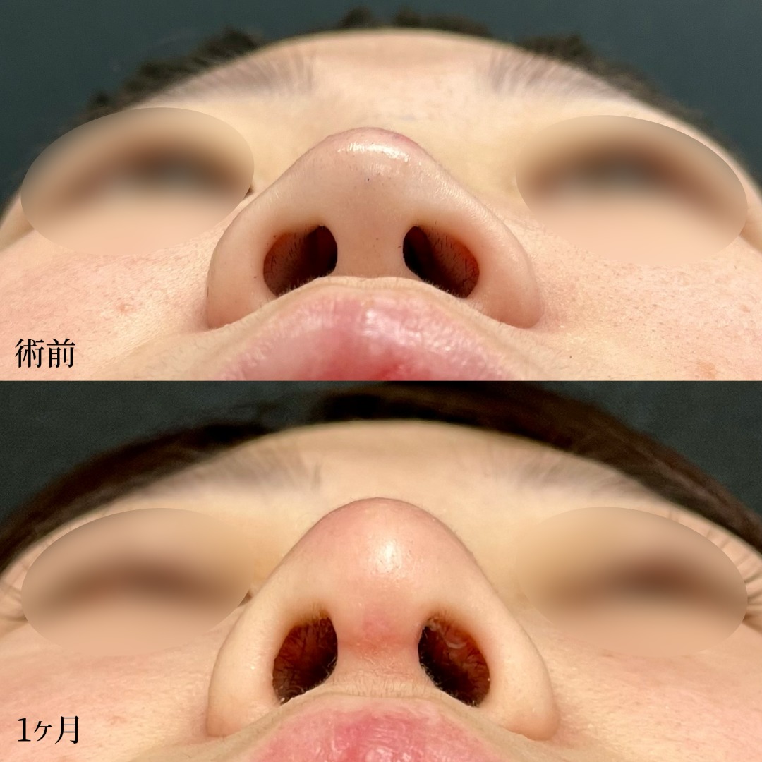 大宮の20代女性の鼻柱下降術の症例