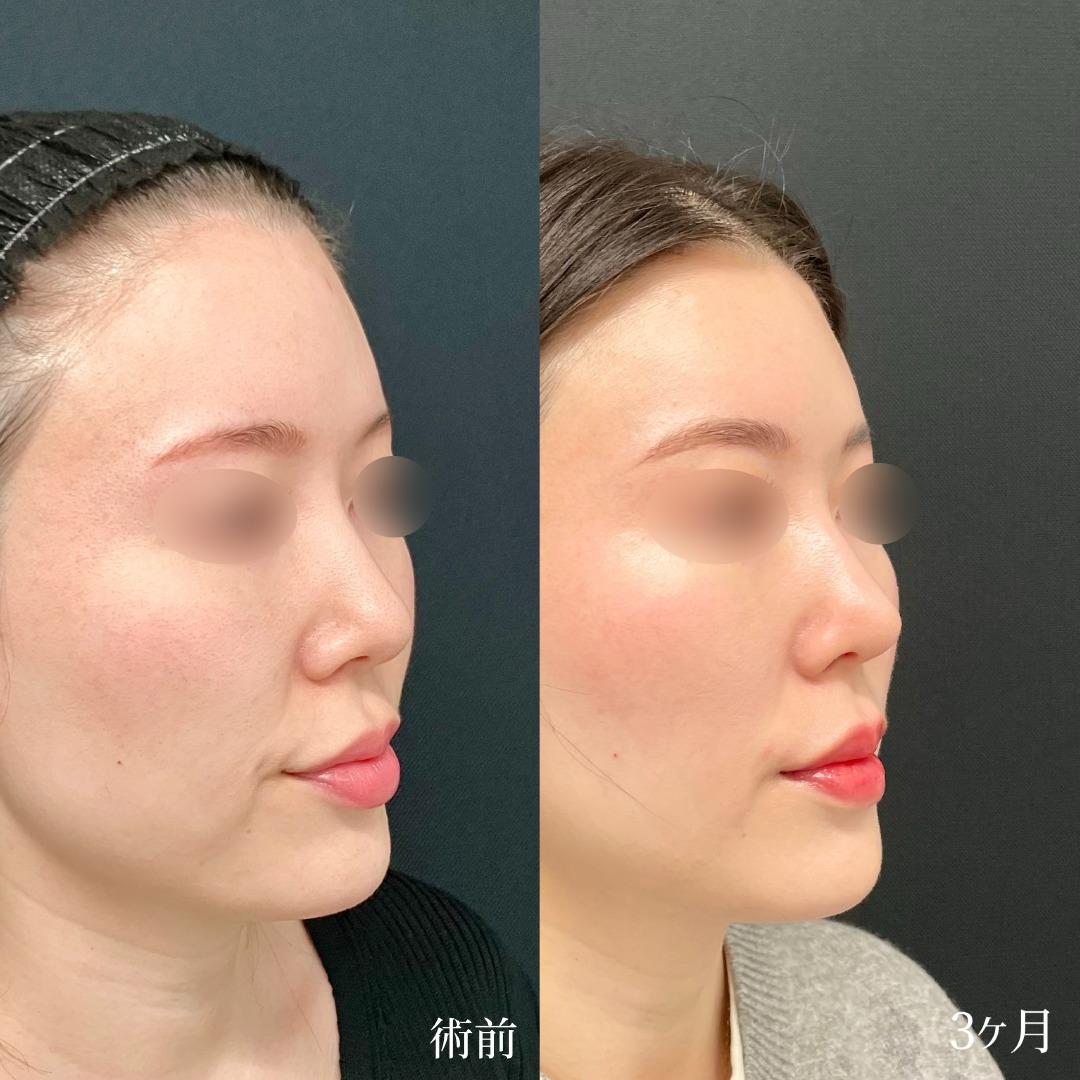 大宮の30代女性のMD式鼻尖形成と軟骨移植の症例