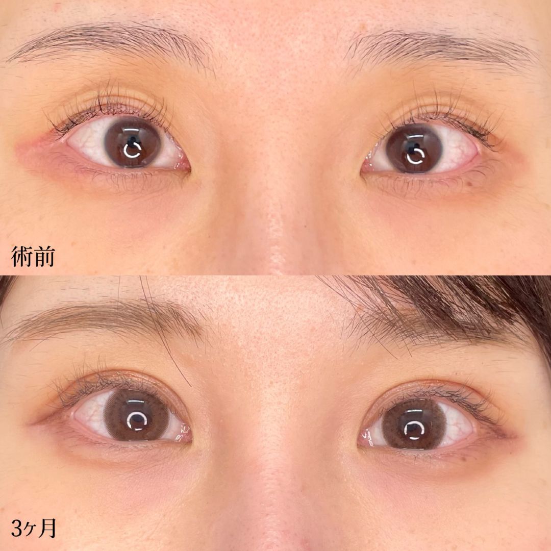 大宮の20代女性の全切開二重術と眼瞼下垂の症例