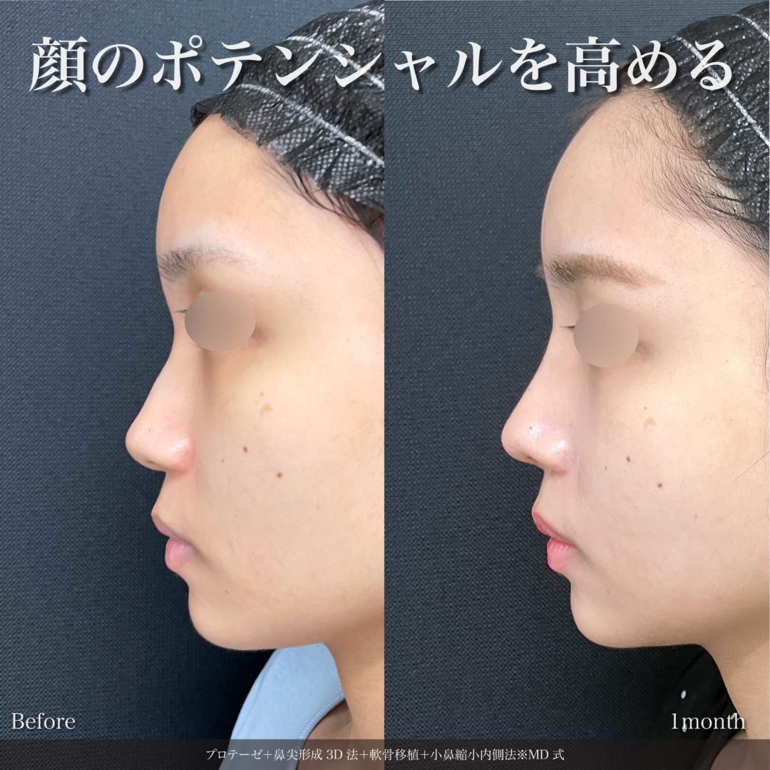 プロテーゼと鼻尖形成3D法と軟骨移植と小鼻縮小内側法をMD式で受けた女性の症例