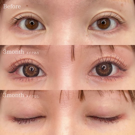 目頭切開と目尻切開の手術後3ヶ月後の症例写真02