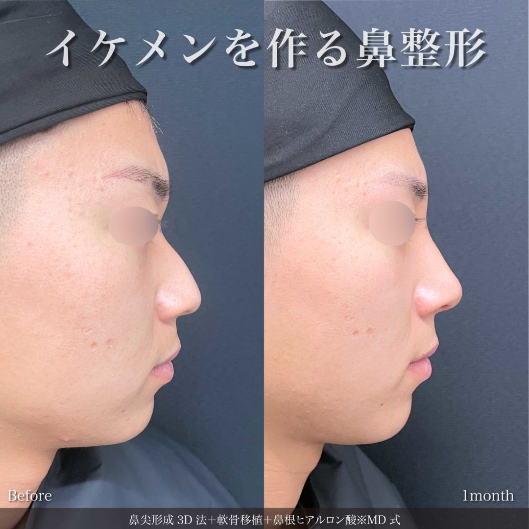 鼻尖形成3D法と軟骨移植と鼻根ヒアルロン酸をMD式で受けた男性の症例写真