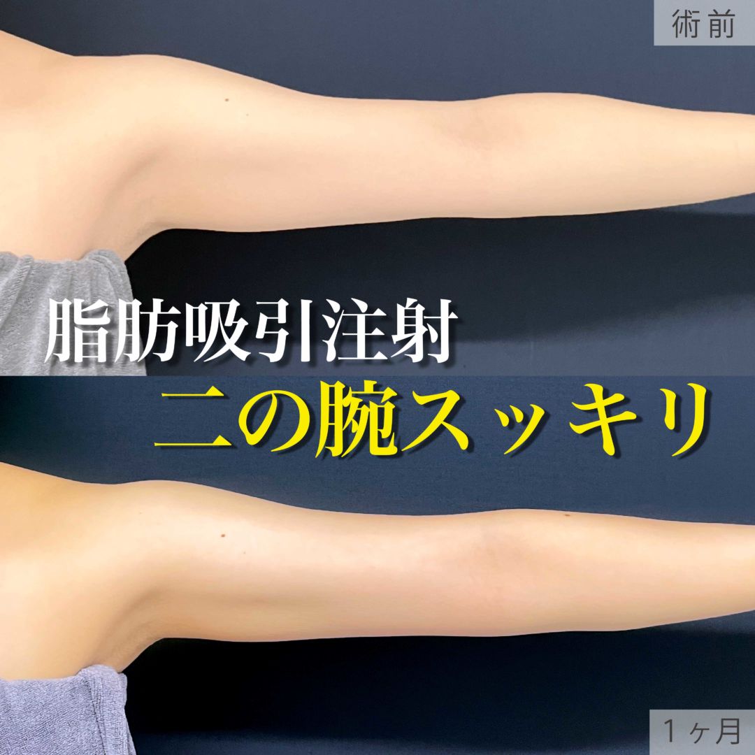 二の腕の脂肪吸引注射の１ヶ月の症例