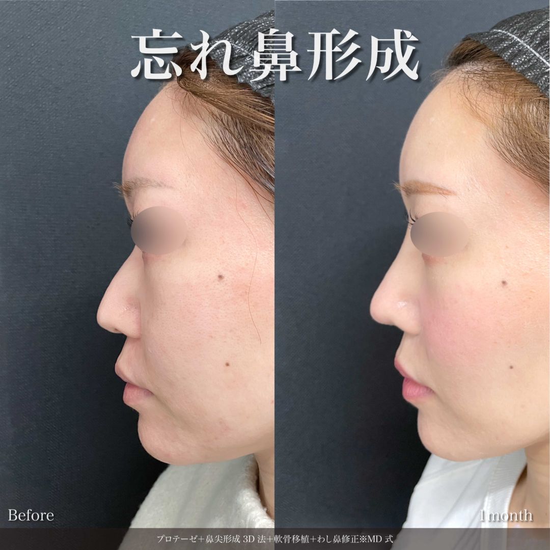プロテーゼと鼻尖形成3D法と軟骨移植とわし鼻修正をMD式で受けた女性の症例写真