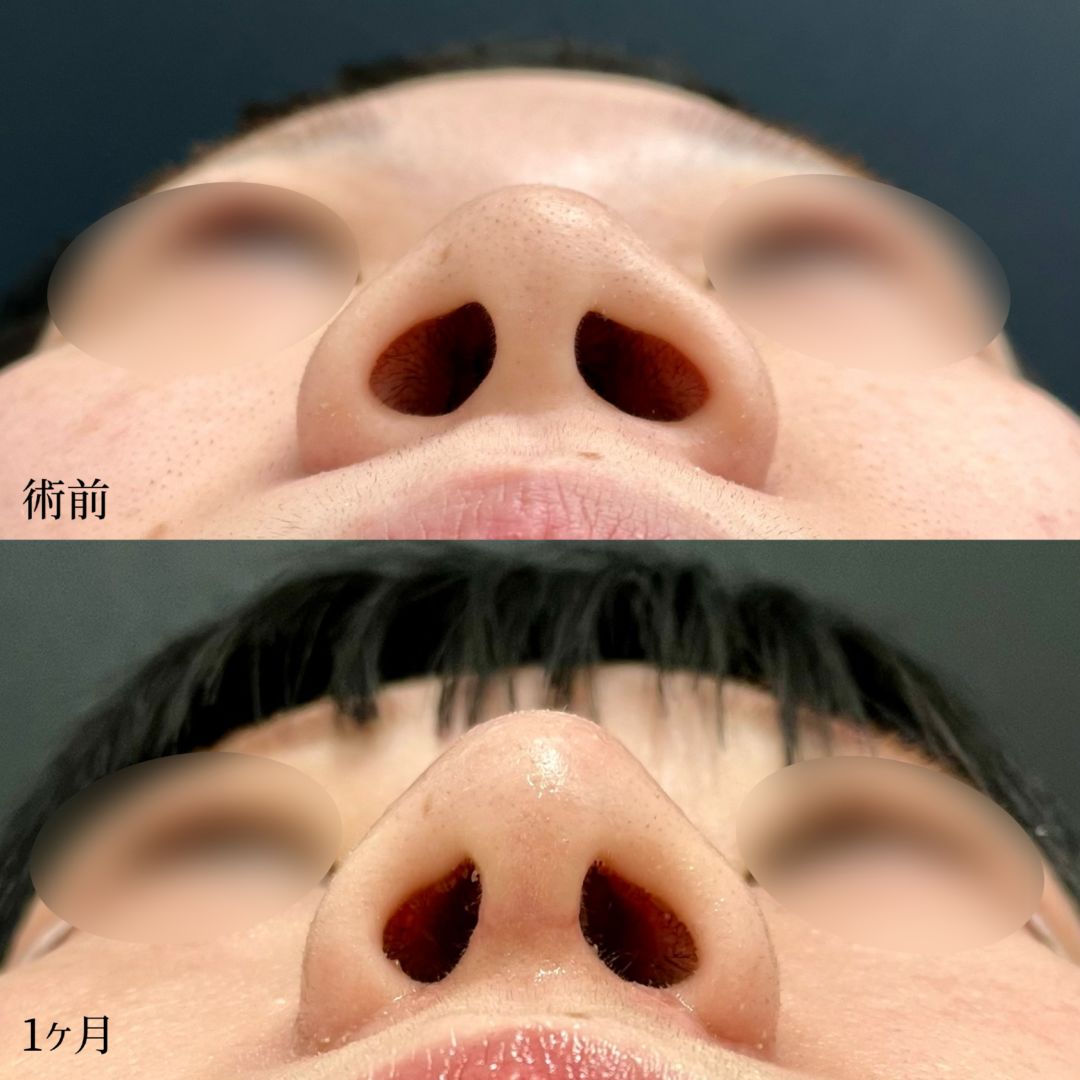 大宮の20代女性の小鼻縮小内外側法の症例