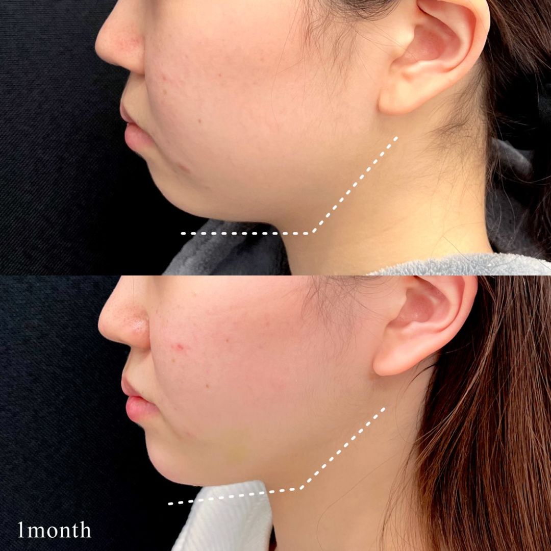 小顔脂肪吸引とヒアルロン酸注入の術後1ヶ月の症例写真