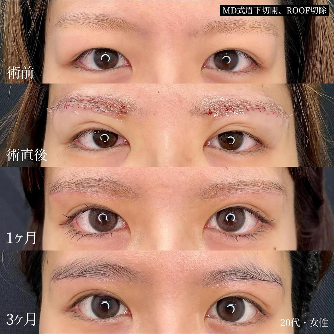 眉下切開の術前と直後、1か月後、3か月後の経過の症例写真