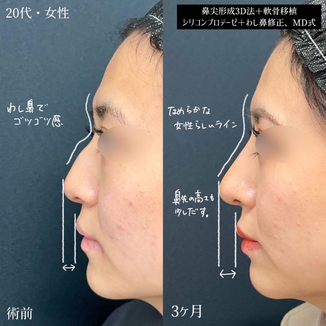 大宮の20代女性の鼻整形の症例と解説