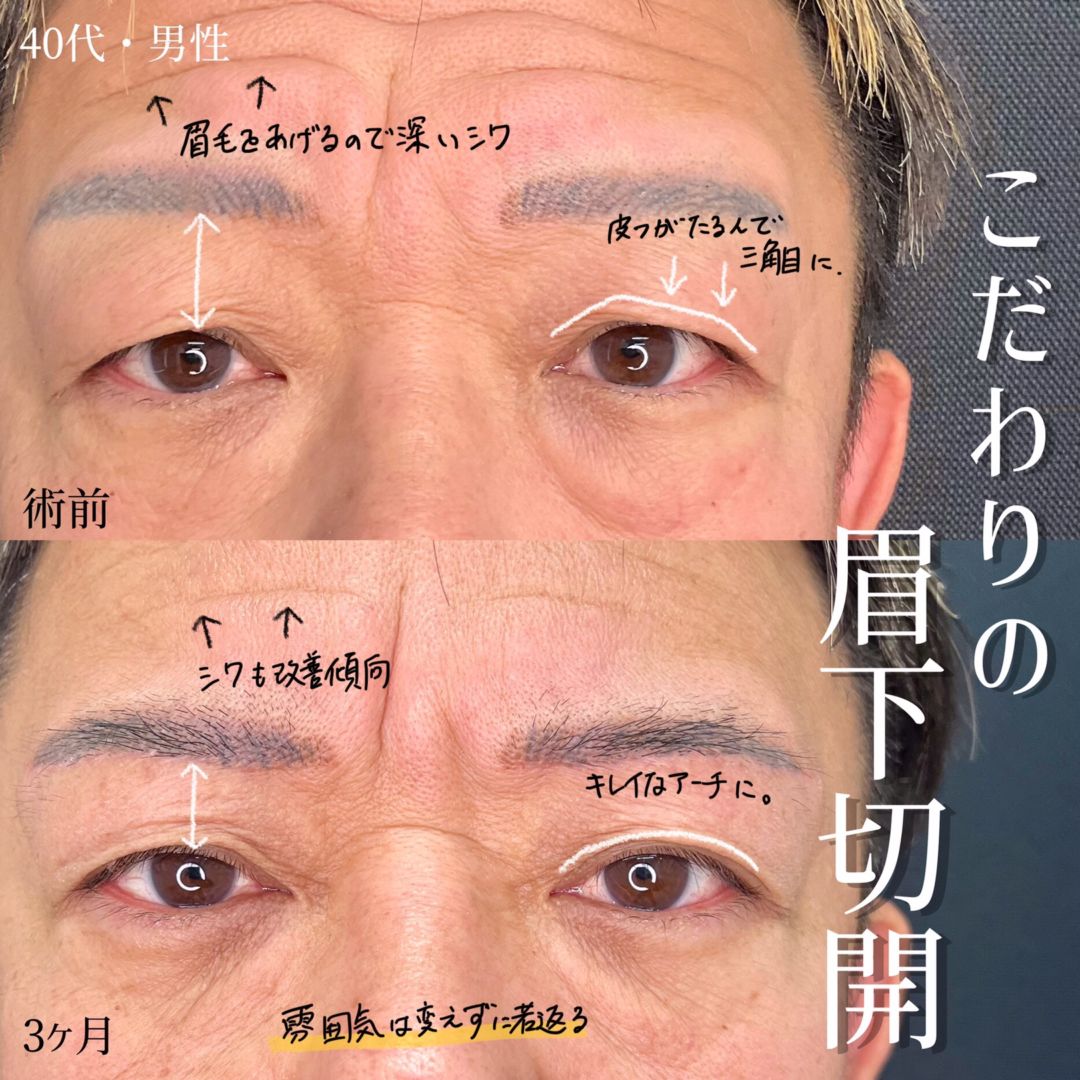 大宮の40代男性の眉下切開の症例