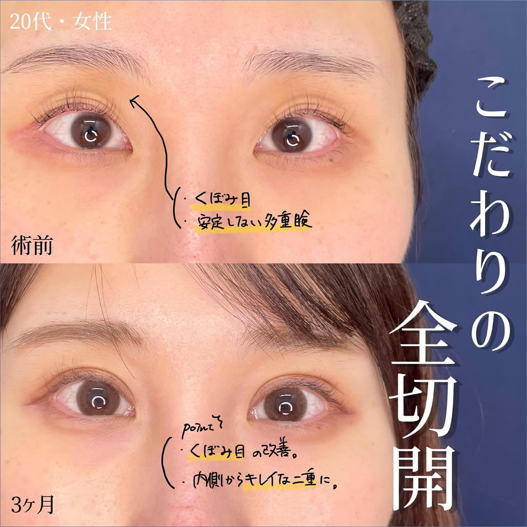 MD式たるみ取り併用全切開と眼瞼下垂の術前と3か月後の症例写真