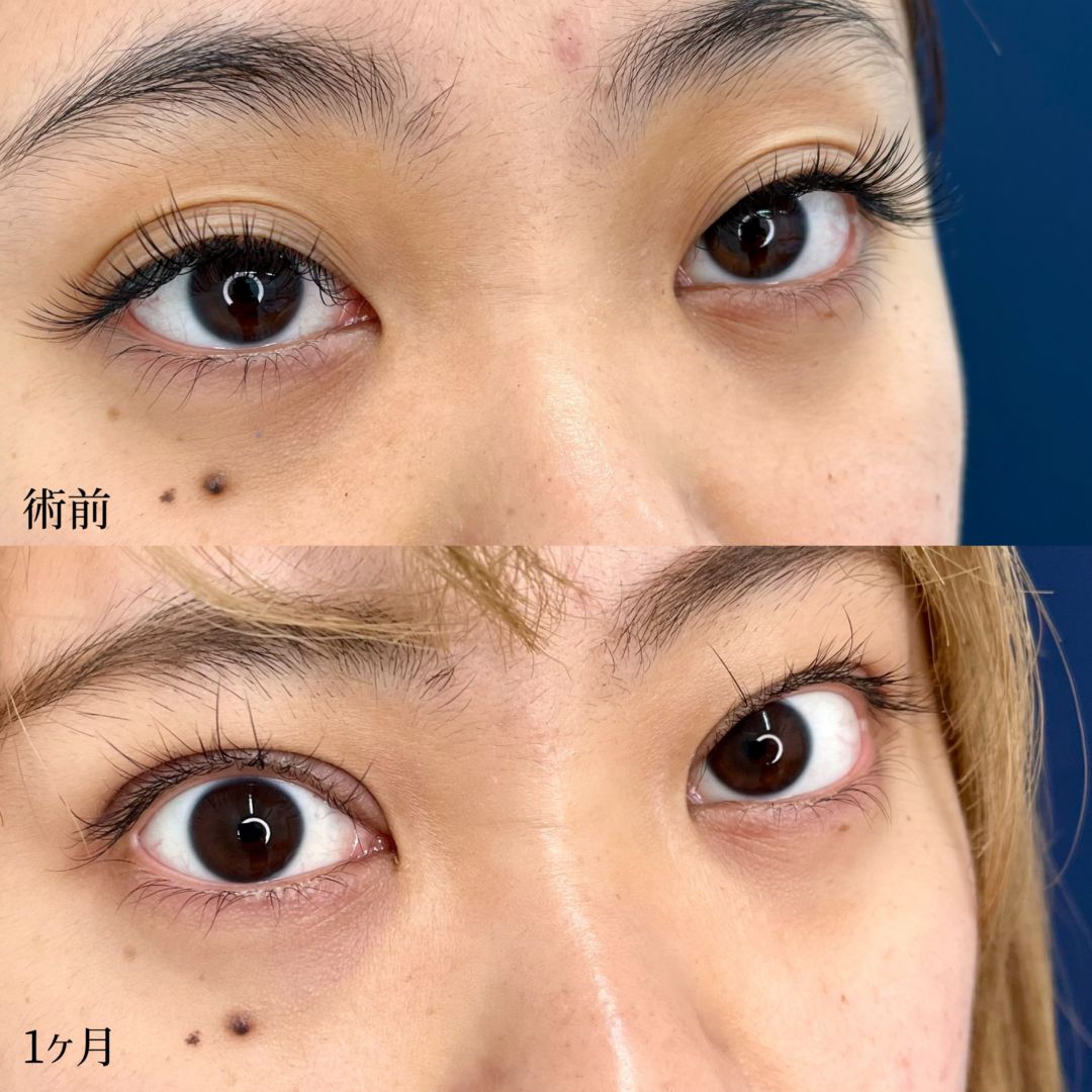 大宮の20代女性のMD式眼瞼下垂の症例