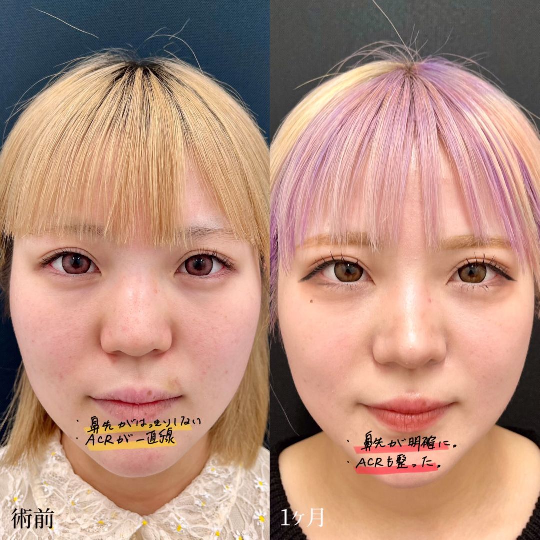大宮の20代女性の鼻尖形成3D法の症例