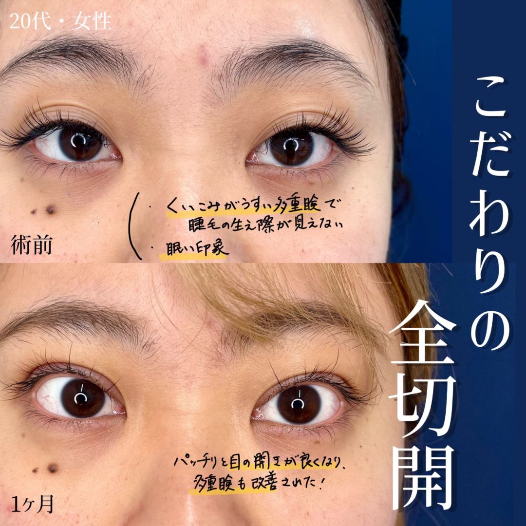 大宮の20代女性のMD式たるみ取り併用全切開と眼瞼下垂の症例