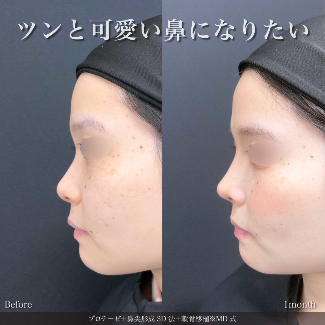 プロテーゼと鼻尖形成3D法と軟骨移植をMD式で受けた女性の症例写真