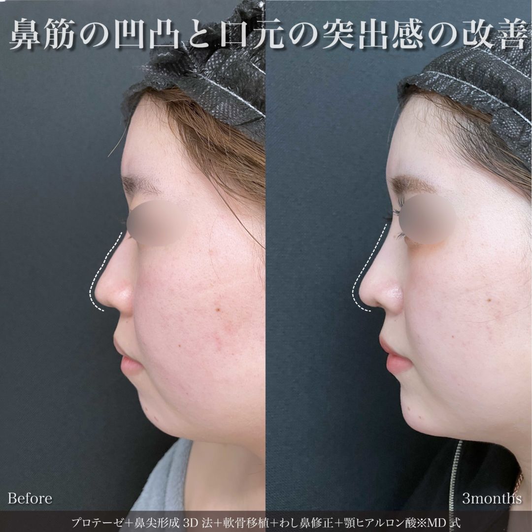 プロテーゼと鼻尖形成3D法と軟骨移植とわし鼻修正と顎ヒアルロン酸をMD式で受けた女性の症例写真