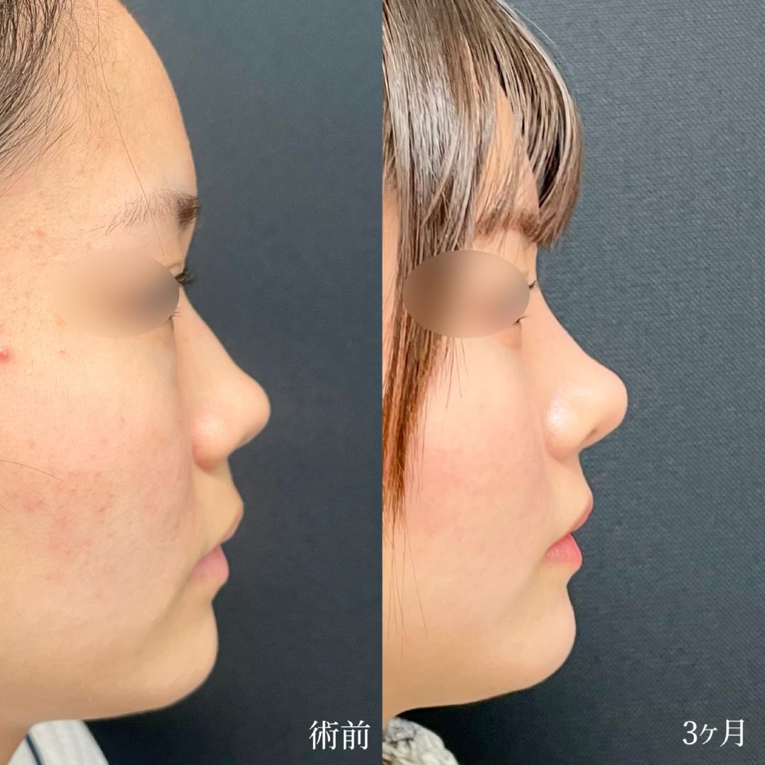 大宮の10代女性の鼻尖形成の症例