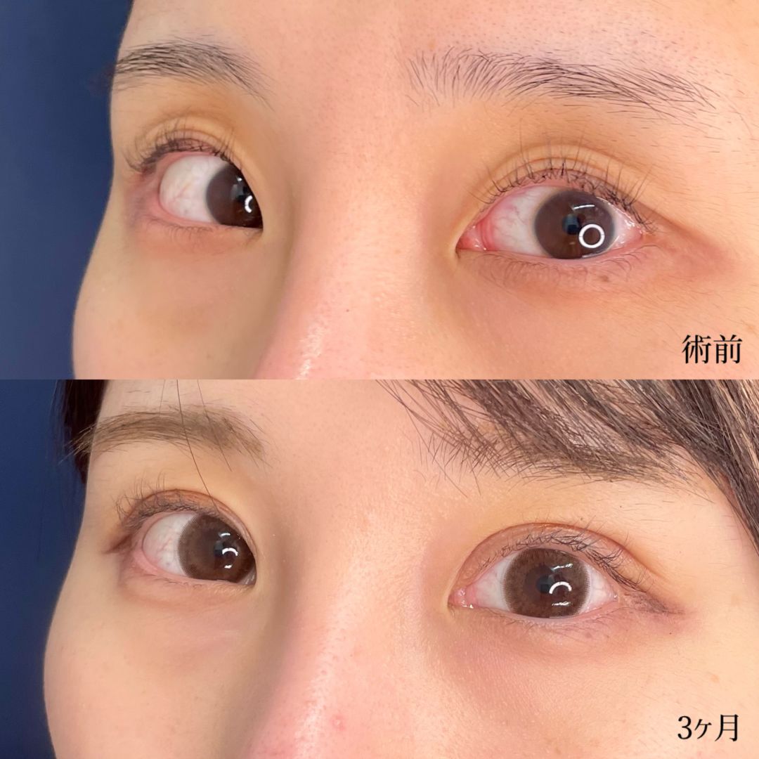 大宮の20代女性のたるみ取り併用全切開二重術と眼瞼下垂の症例