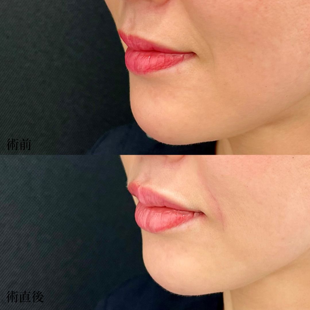 大宮の40代女性の唇のヒアルロン酸の経過