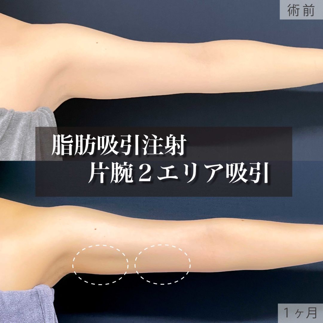 二の腕の脂肪吸引注射の１ヶ月の症例
