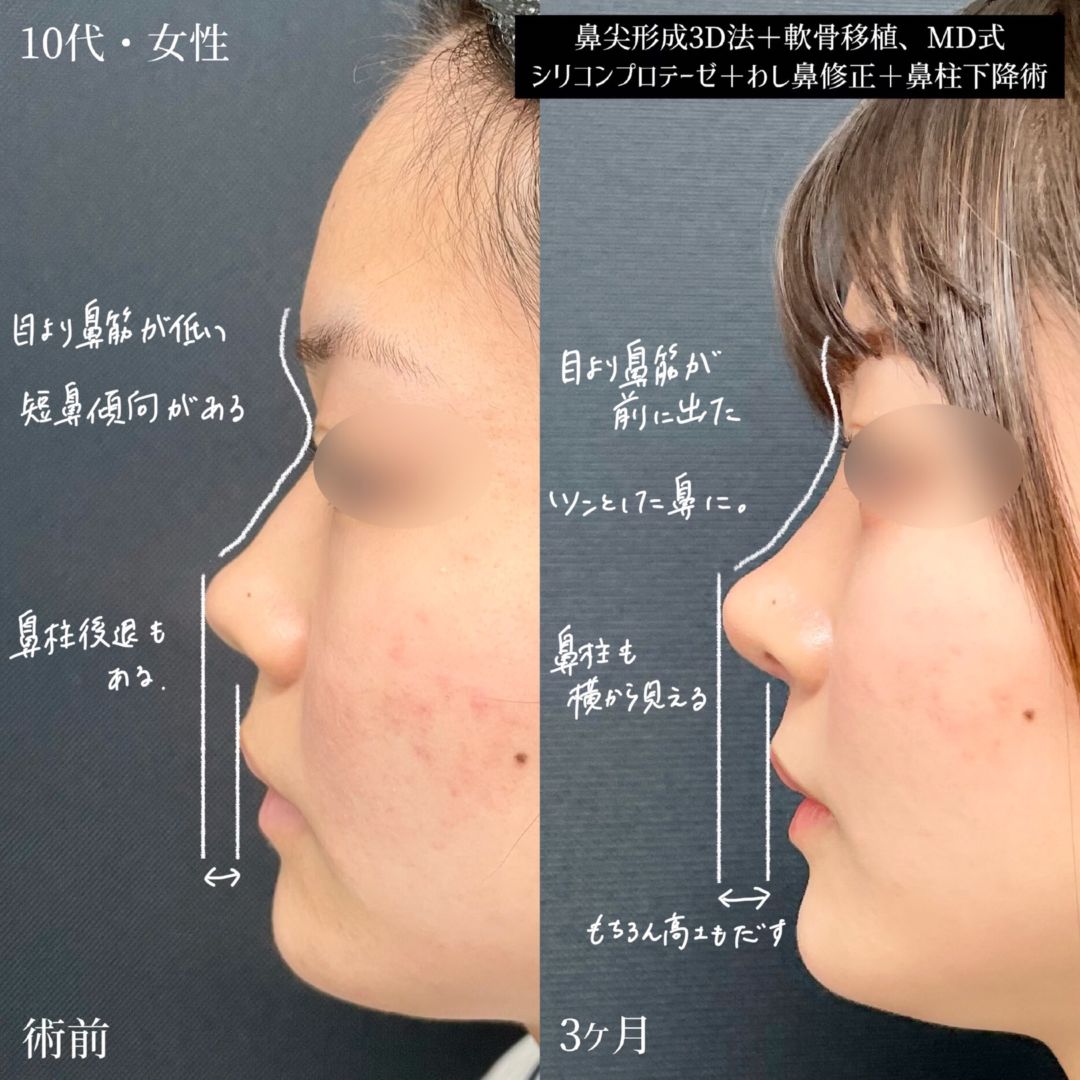 大宮の10代女性の鼻整形の症例