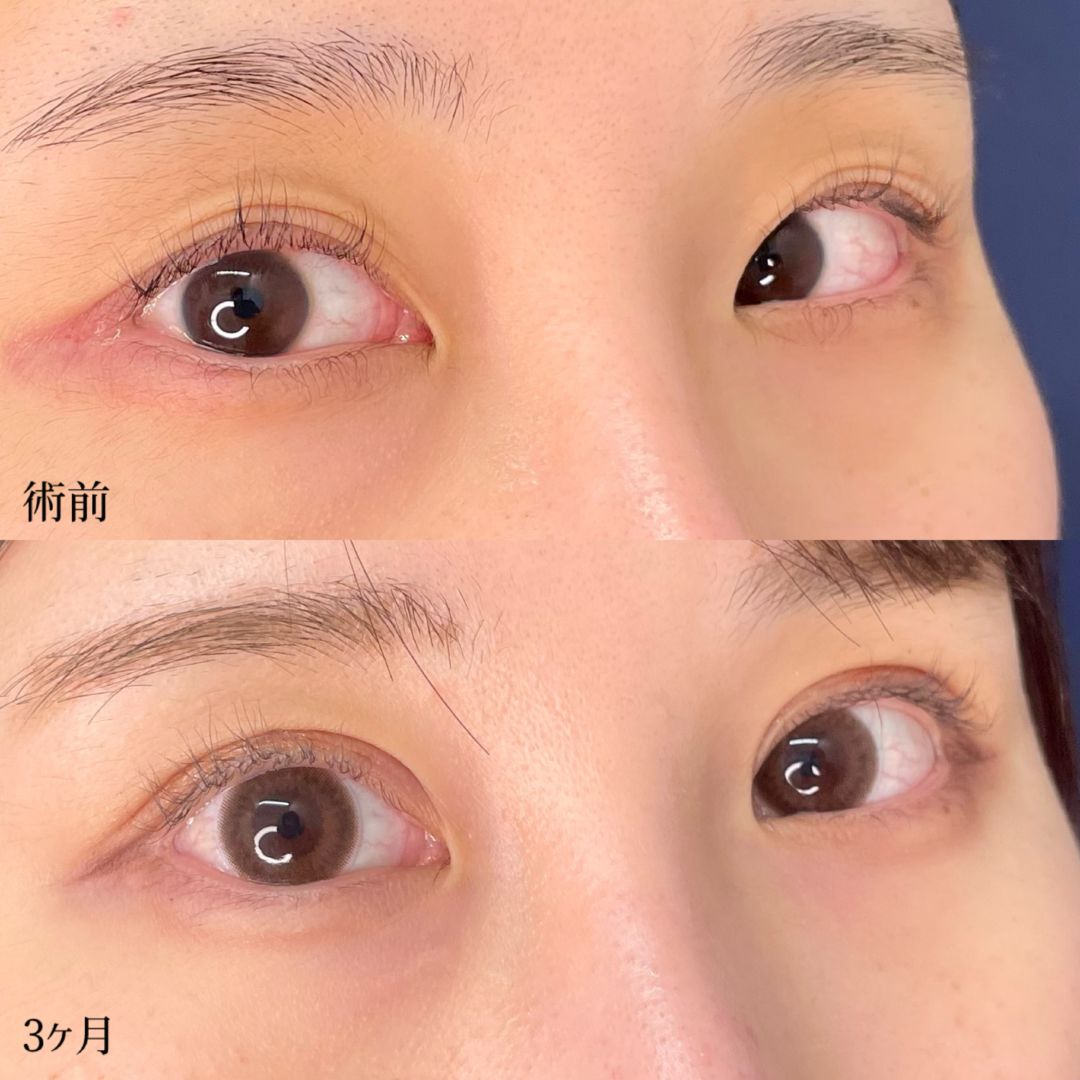 大宮の20代女性のMD式たるみ取り併用全切開二重術と眼瞼下垂の症例