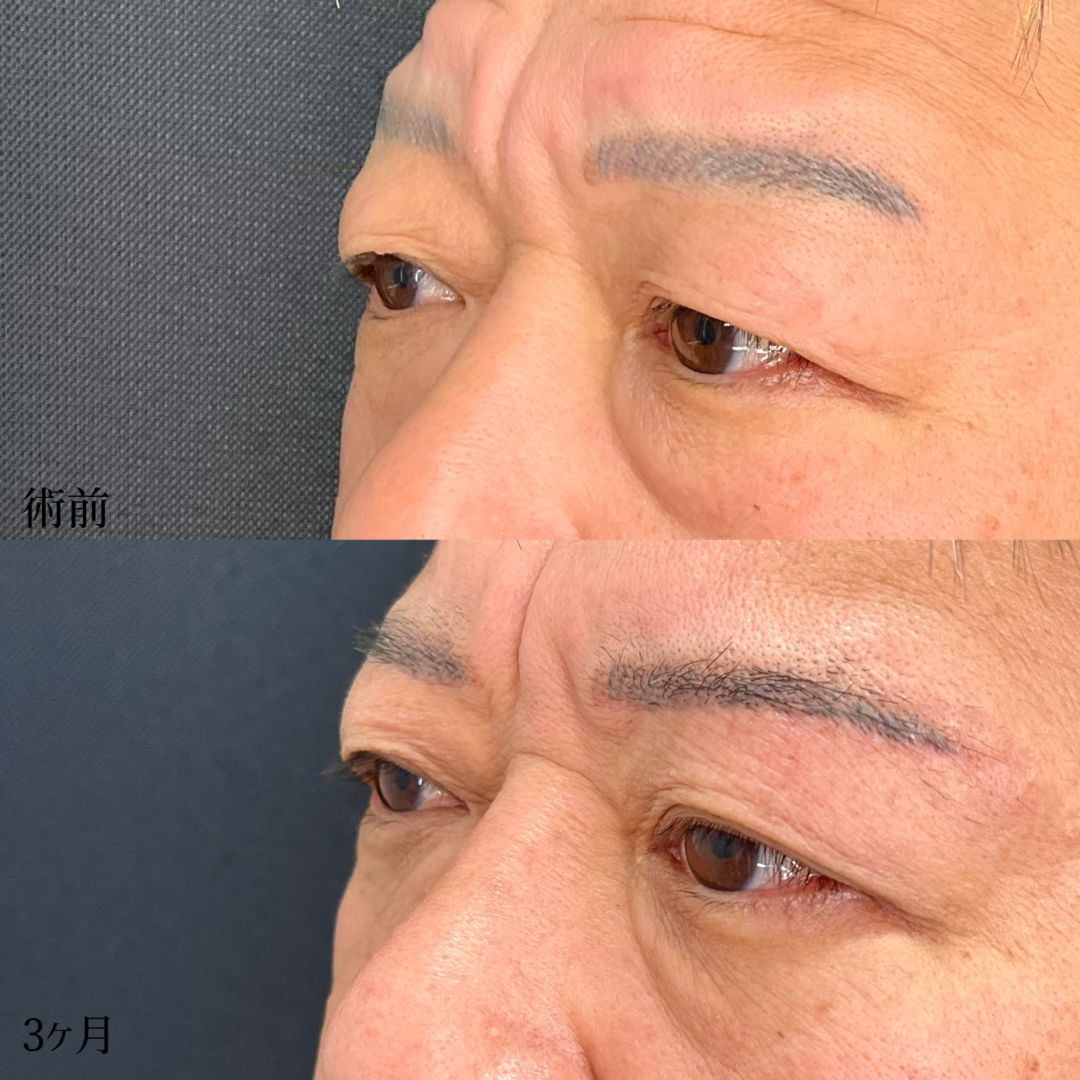 大宮の40代男性のMD式眉下切開の症例