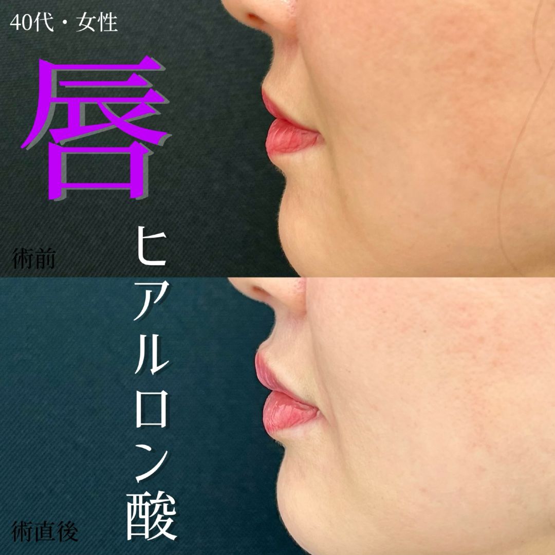 大宮の40代女性の唇のヒアルロン酸の症例