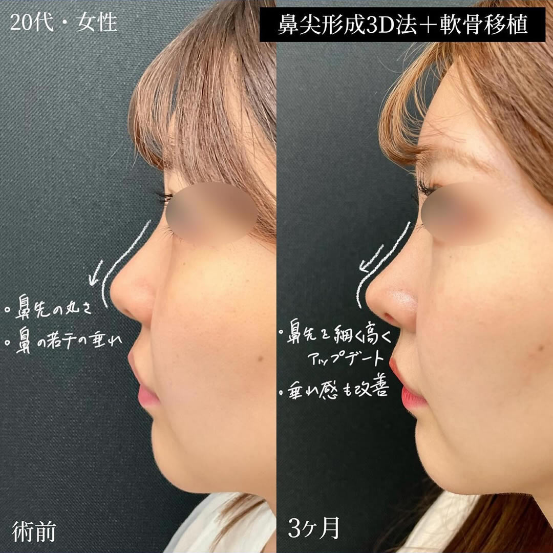 鼻尖形成3D法と軟骨移植の症例写真