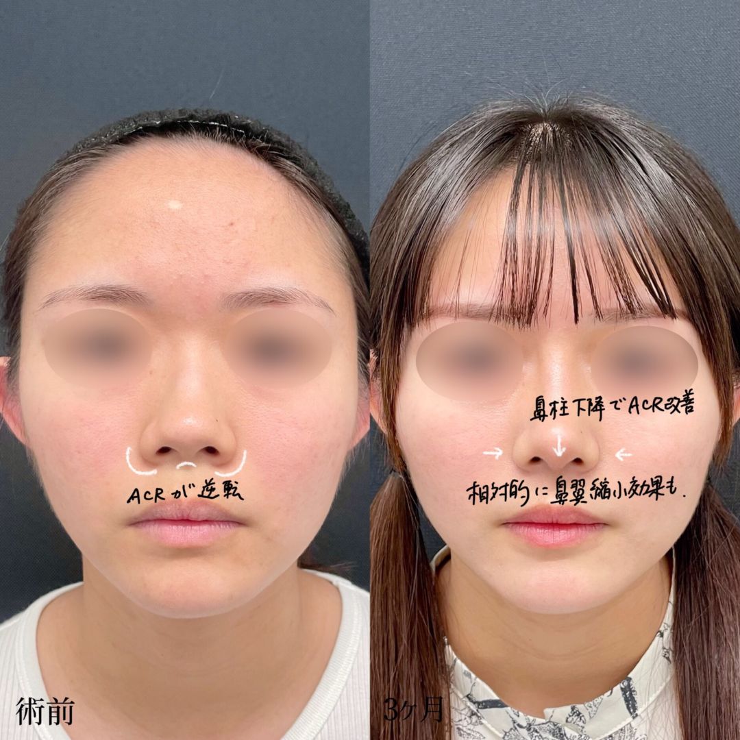 大宮の10代女性の鼻柱下降術の症例