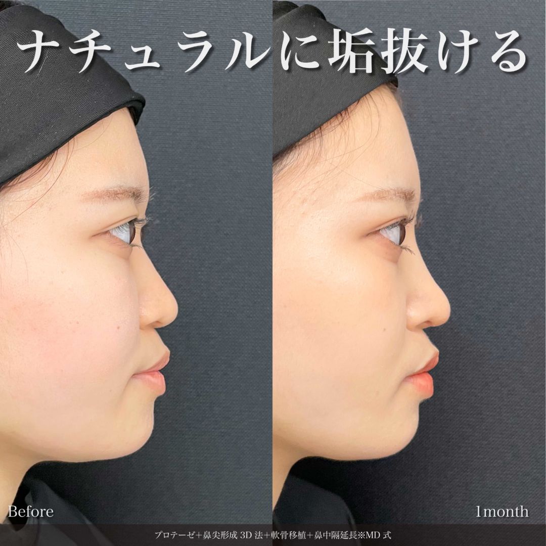 プロテーゼと鼻尖形成3D法と軟骨移植と鼻中隔延長をMD式で受けた女性の症例写真