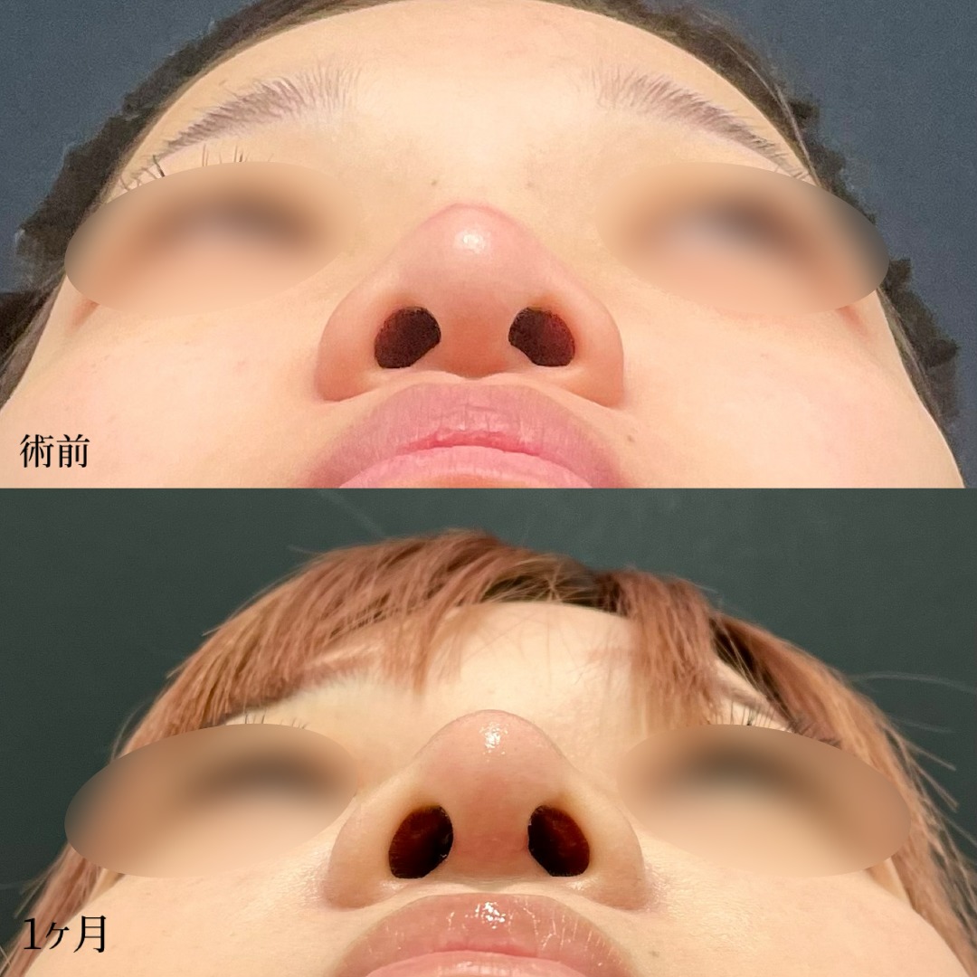 大宮の20代女性の鼻翼基部プロテーゼの症例