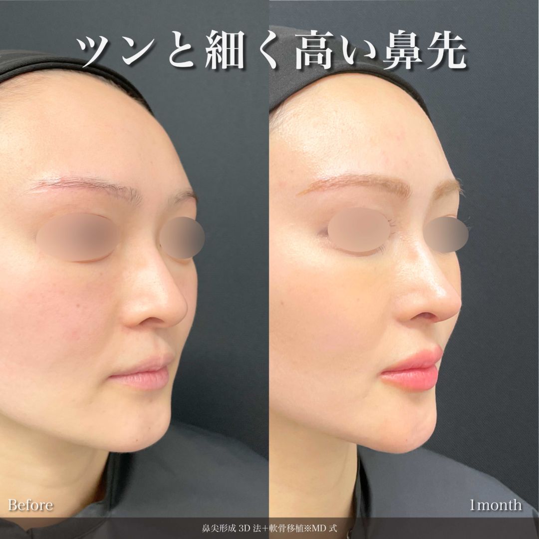 鼻尖形成3D法と軟骨移植をMD式で受けた女性の症例写真