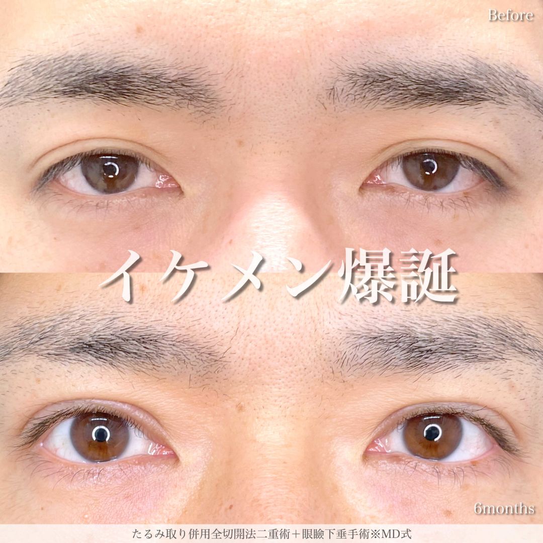 たるみ取り併用全切開法二重術と眼瞼下垂手術をMD式で受けた男性の症例写真