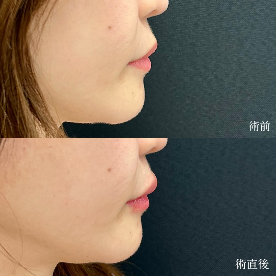 大宮の30代女性の唇のヒアルロン酸の症例
