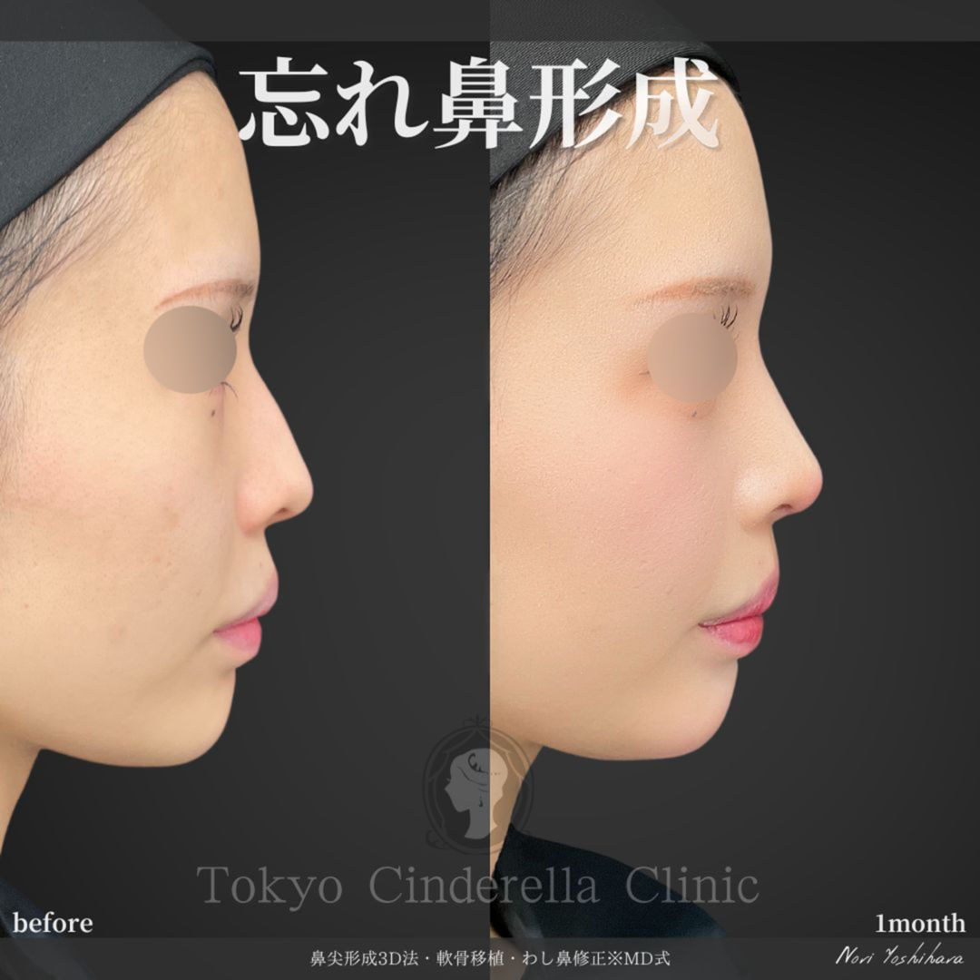 鼻尖形成3D法と軟骨移植とわし鼻修正を受けた女性の症例写真