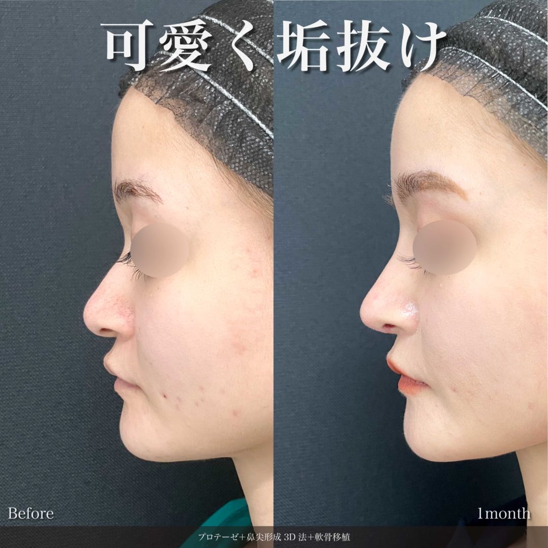 プロテーゼと鼻尖形成3D法と軟骨移植を受けた女性の症例写真
