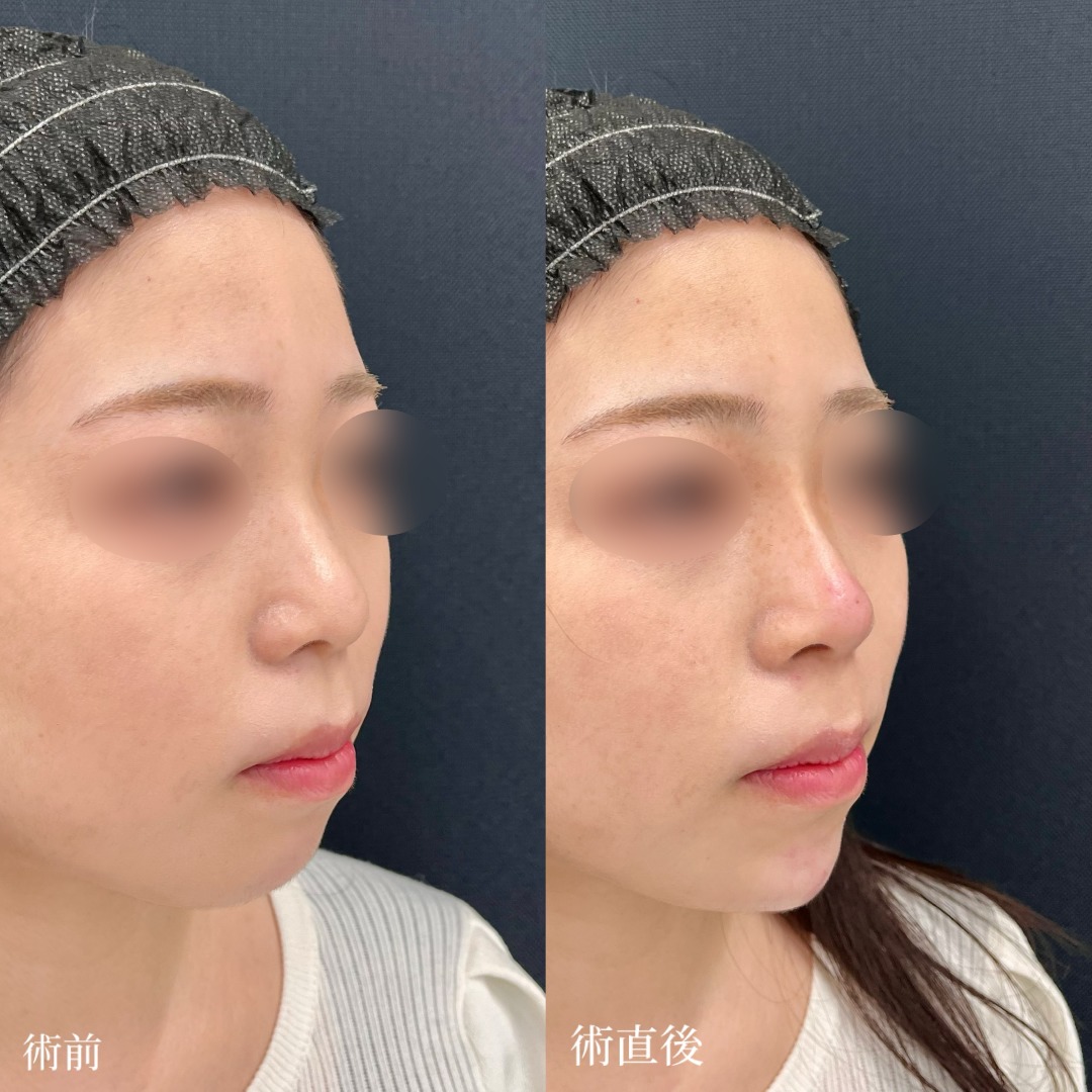 大宮の20代女性の鼻あごヒアルロン酸の症例