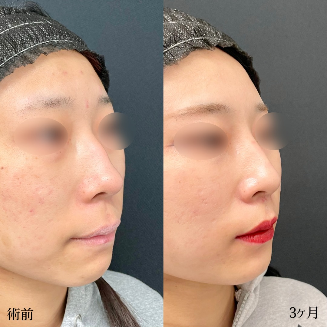 大宮の20代女性のプロテーゼとわし鼻修正の症例