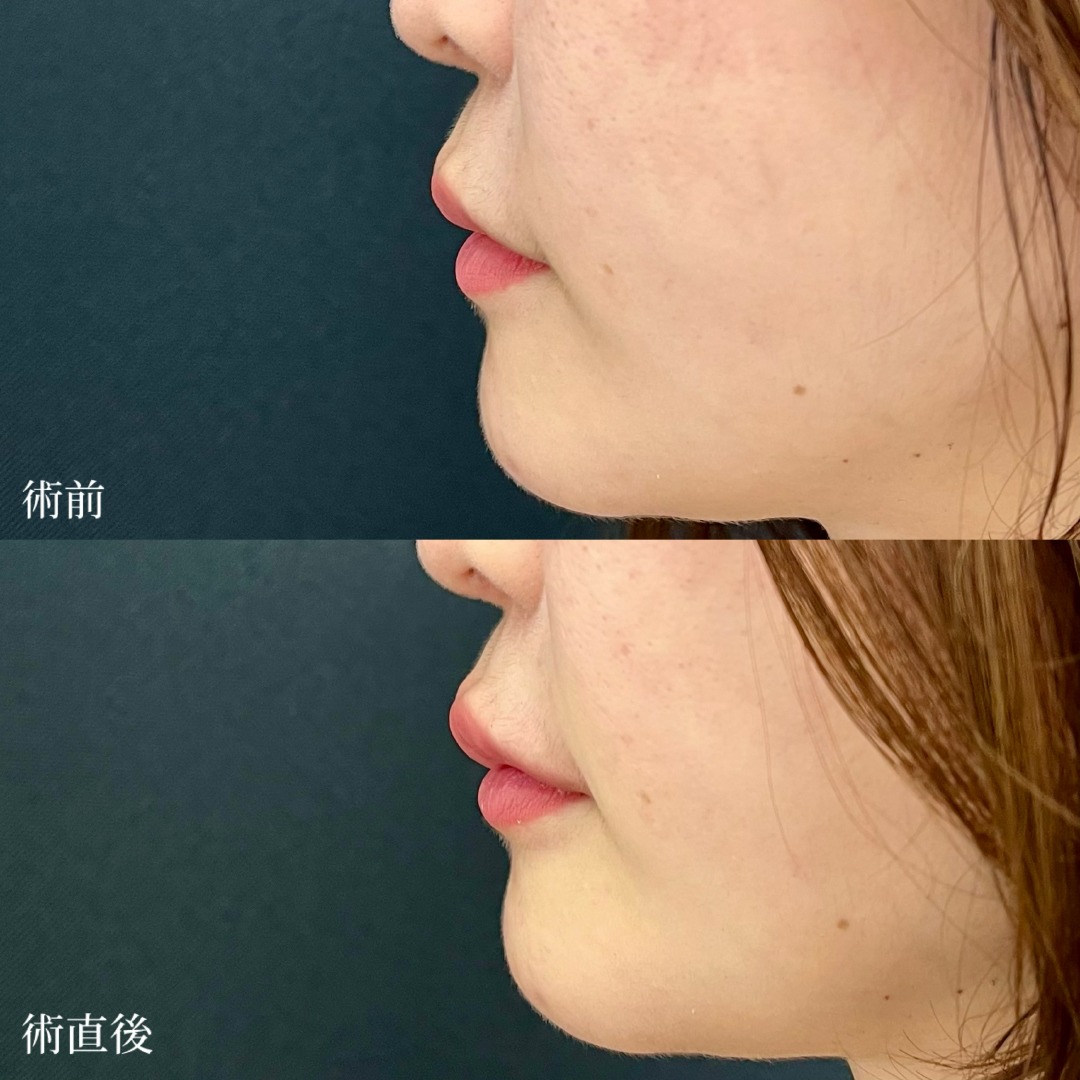 大宮の30代女性の唇ヒアルの症例