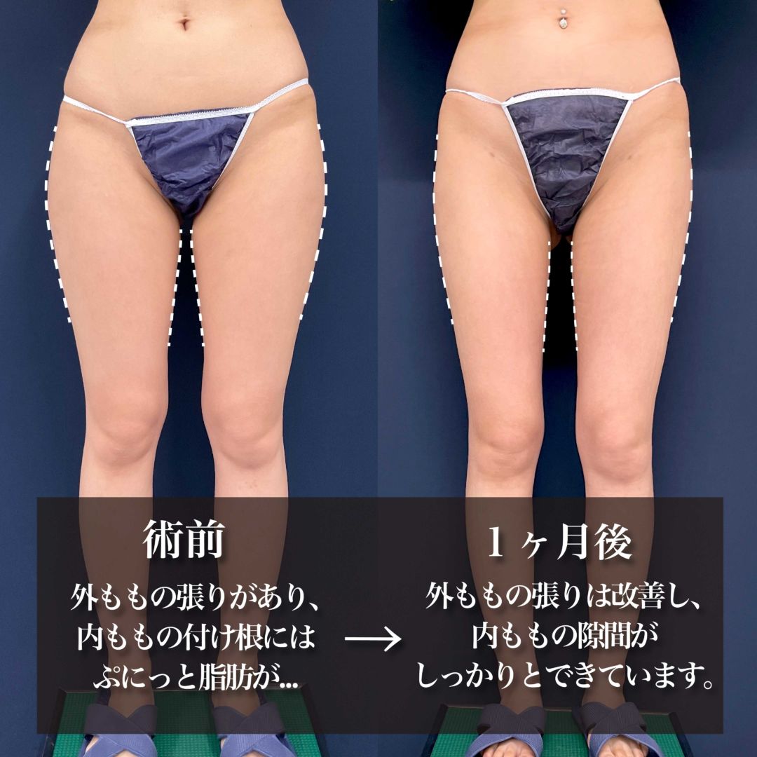 アキーセル脂肪吸引で太ももスッキリ痩せした20代女性の症例
