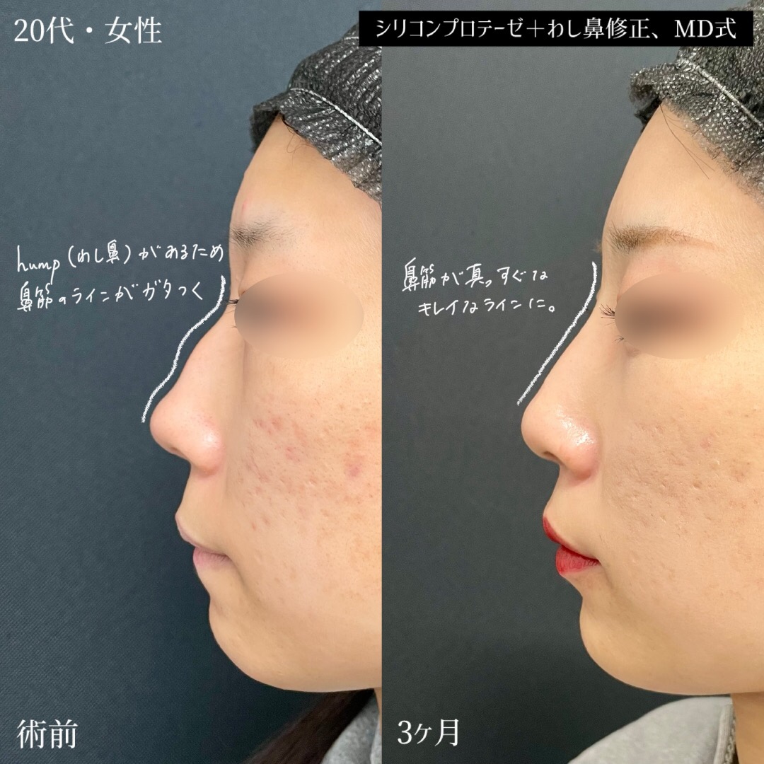 大宮の20代女性の鼻整形の症例