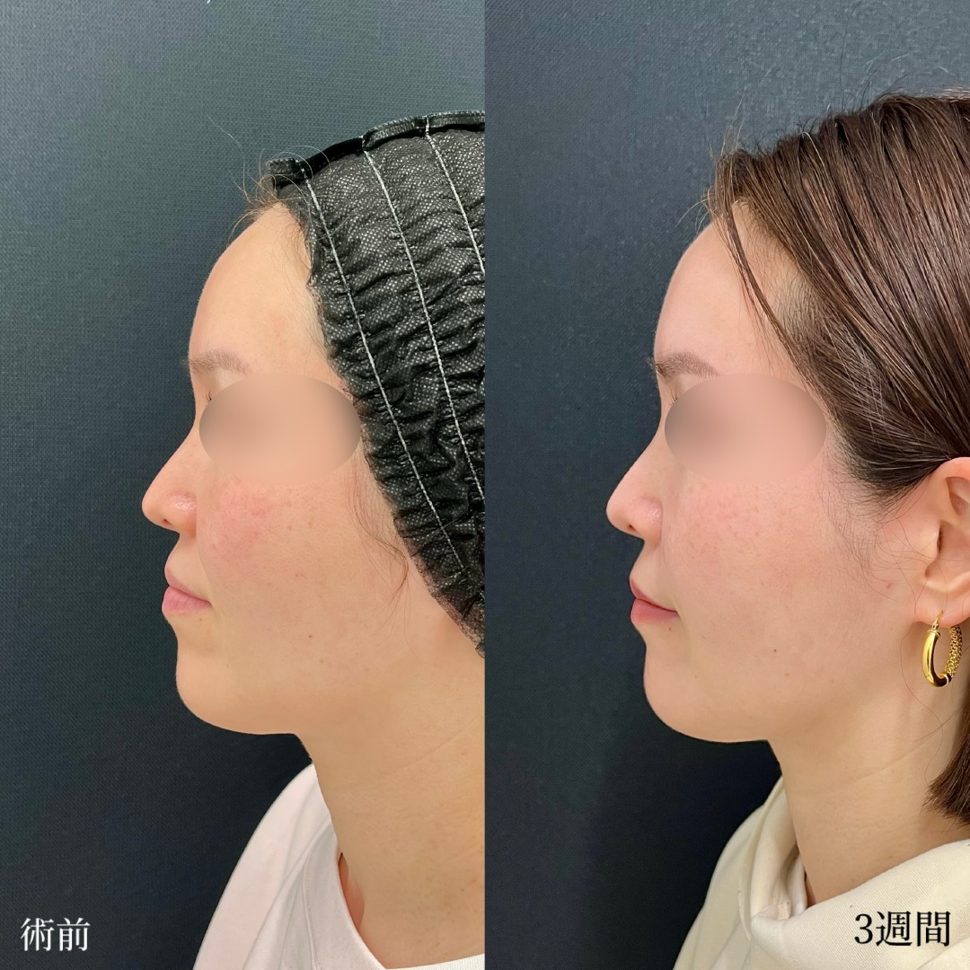 大宮の40代女性の糸リフトと頬と鼻翼基部ヒアルロン酸の症例