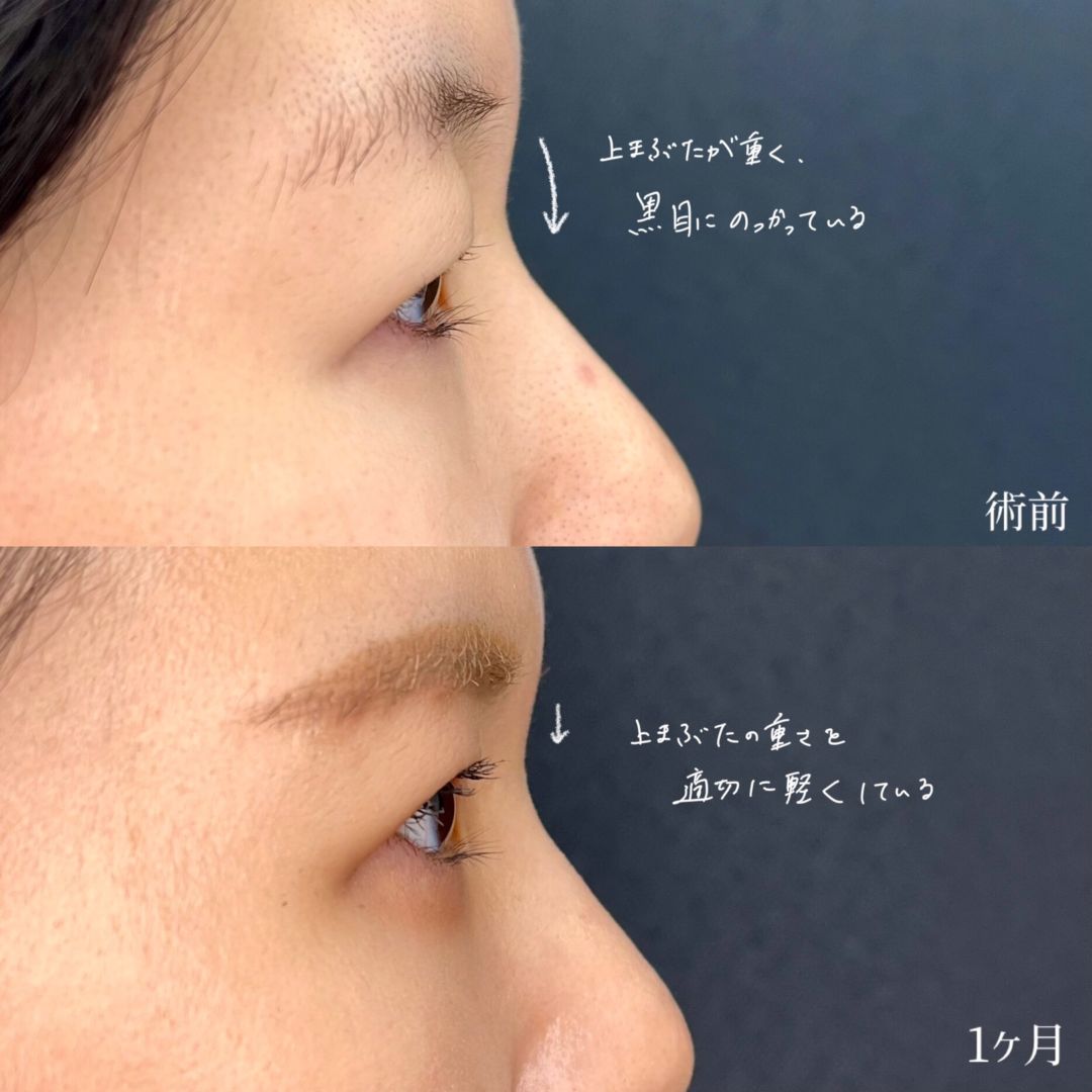大宮の30代女性のMD式眉下切開の症例