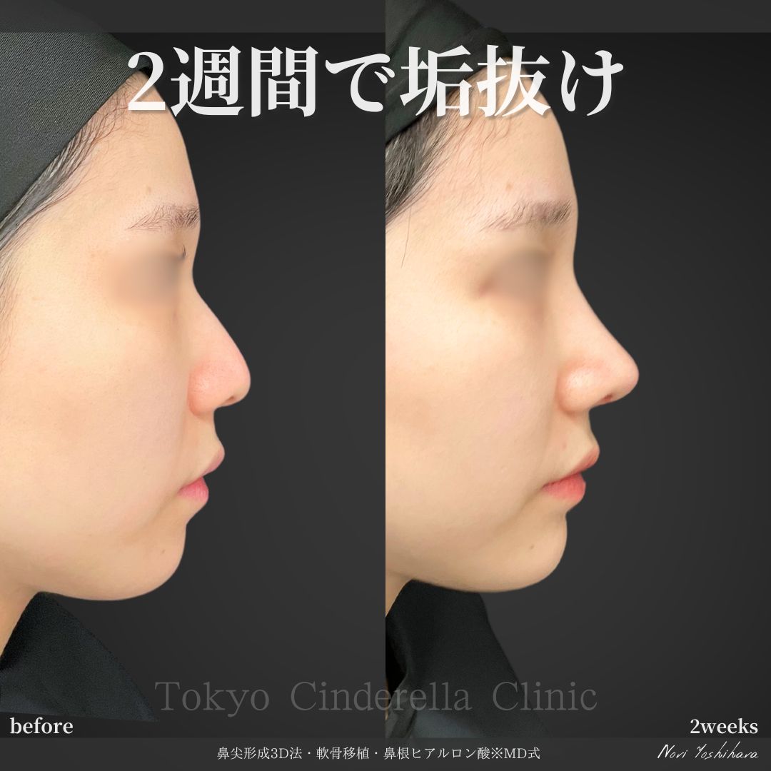 鼻尖形成3D法と軟骨移植と鼻根ヒアルロン酸を受けた女性の症例写真