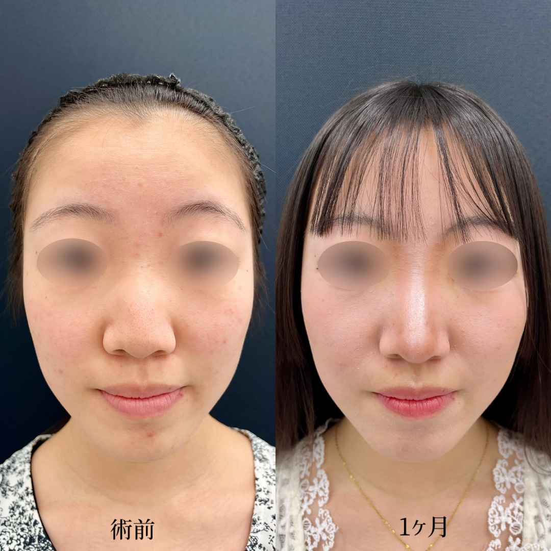 大宮の10代女性の鼻整形の症例