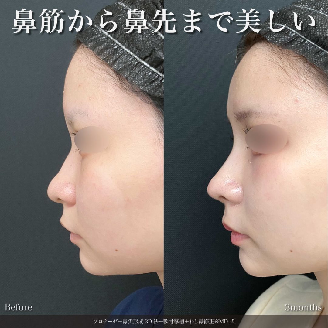 プロテーゼと鼻尖形成3D法と軟骨移植と鷲鼻修正をMD式で受けた女性の症例写真