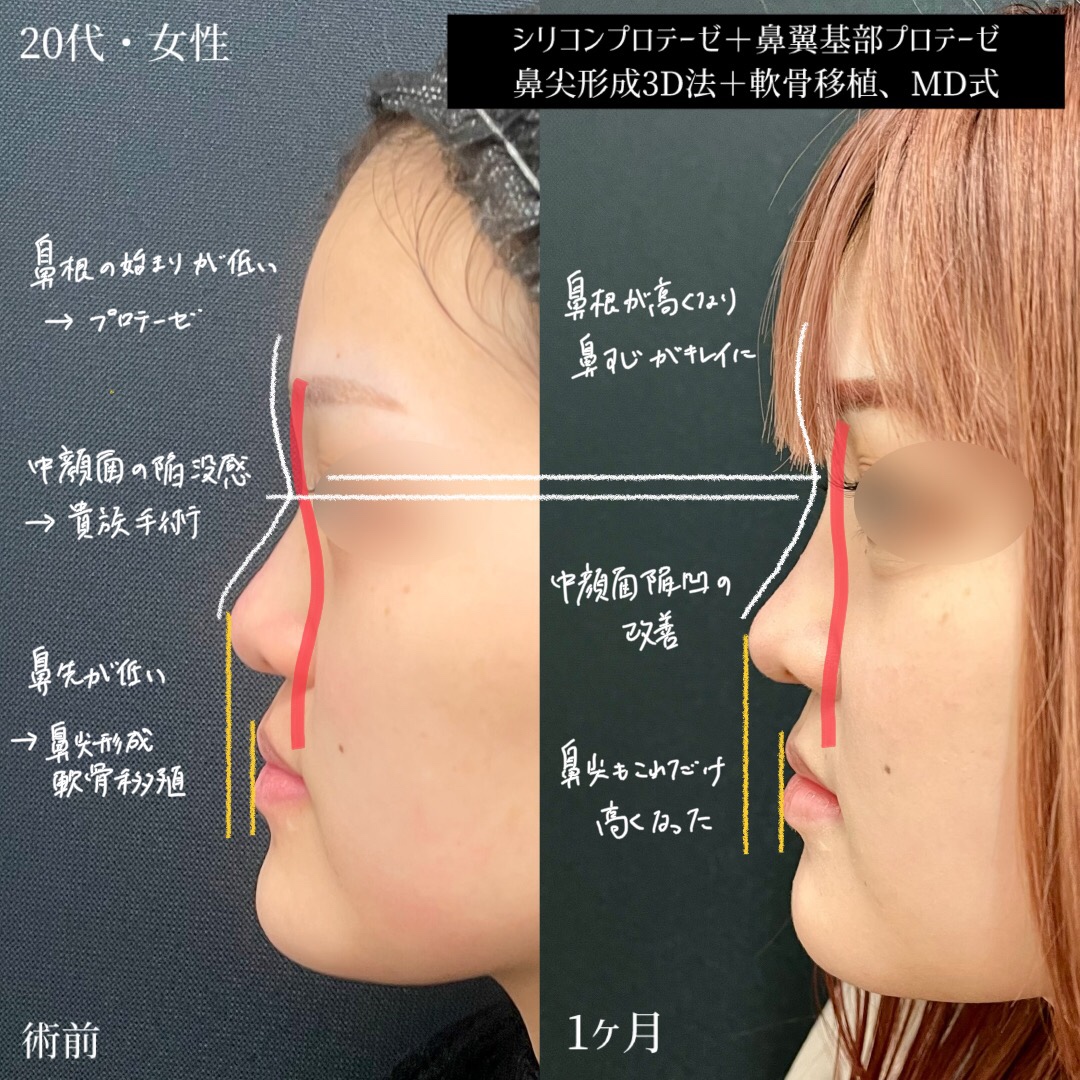 大宮の20代女性の鼻整形の症例