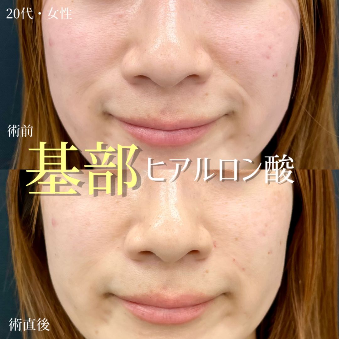大宮の20代女性の鼻翼基部ヒアルロン酸の症例