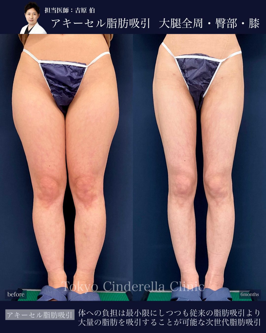 太ももとお尻と膝のアキーセル脂肪吸引を受けた女性の症例写真